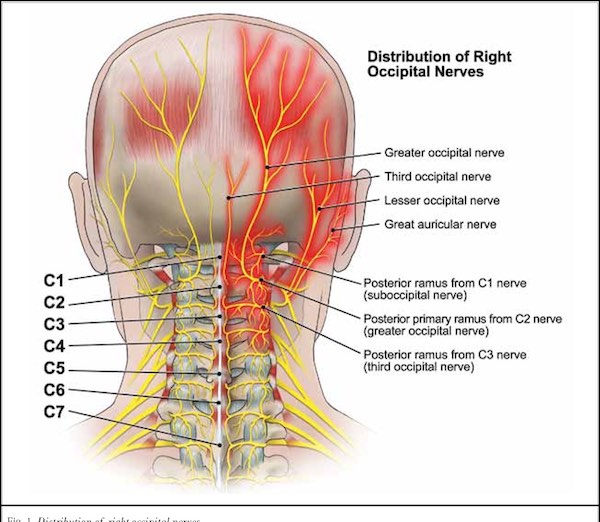 Headache And Neck Pain Is It Possible That Nerve Compression Is To Blame