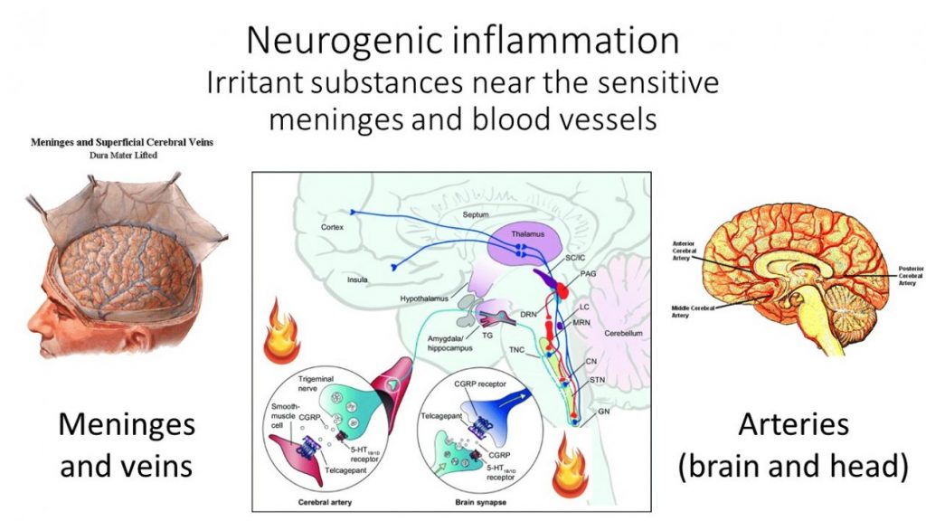 neurogenic inflammation 