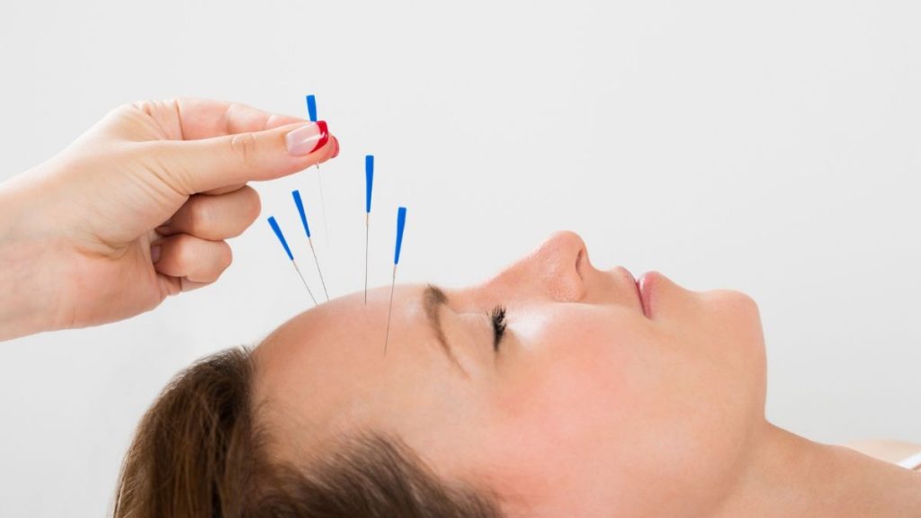 Young Woman Receiving Acupuncture Treatment