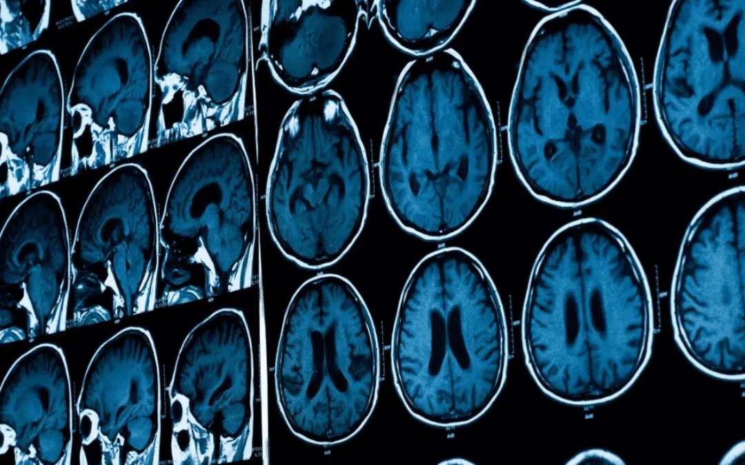 Should I Be Concerned If My Physician Didn’t Prescribe Imaging for Migraine?
