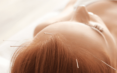 Acupuncture: Is It a Good Option for Migraine?