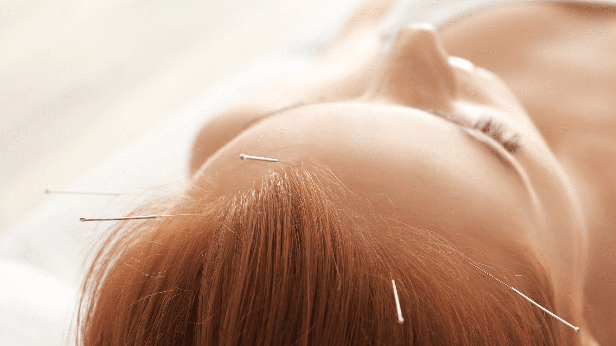 Post 1201 - Acupuncture & Migraine