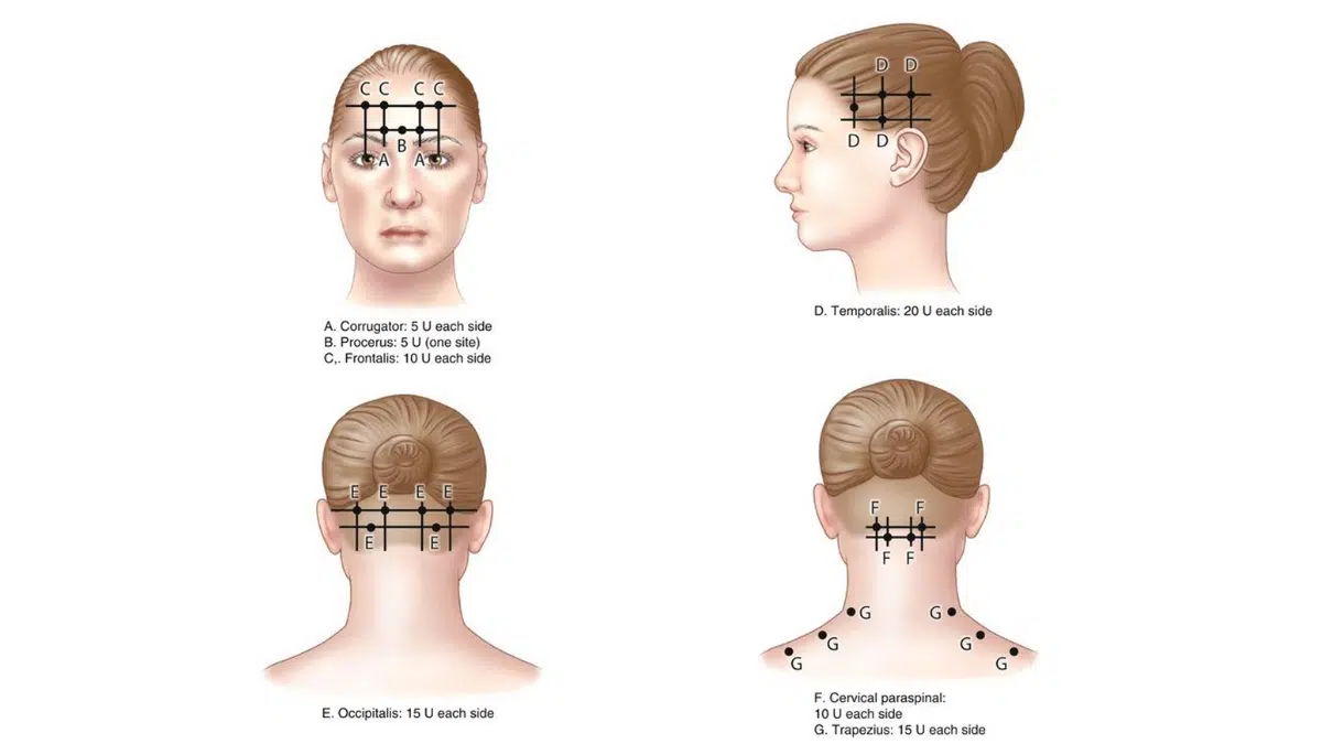 Post 1203 - Botox injection sites
